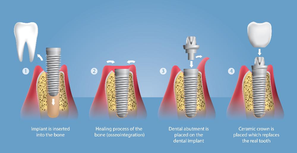 illustration of process for dental implants east hills, NSW