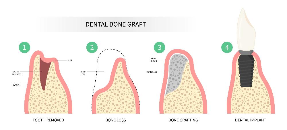 illustration of bone grafting oral surgery East Hills, NSW