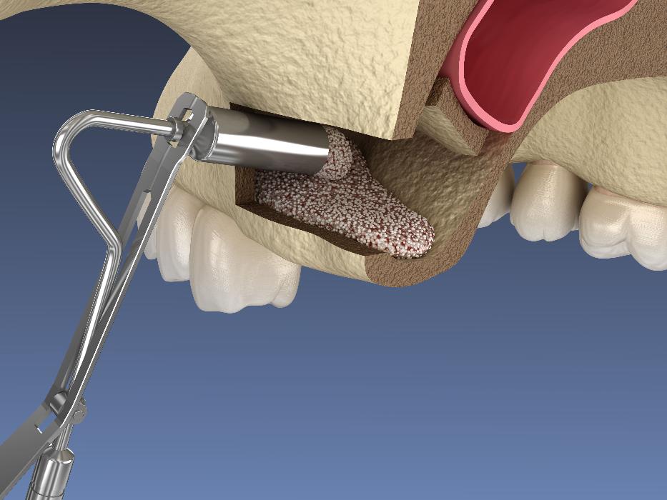 illustration of sinus lift oral surgery East Hills, NSW