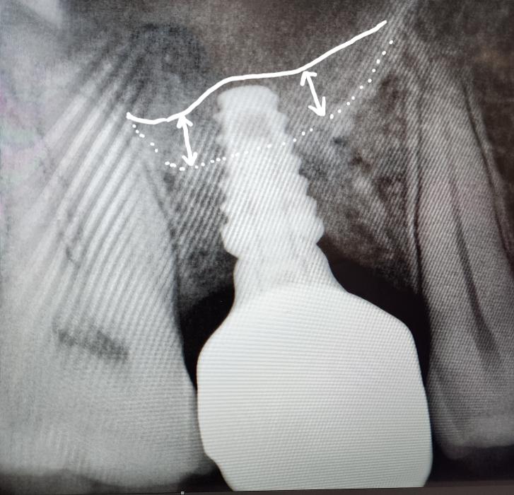 xray with sinus lift dental surgery East Hills NSW