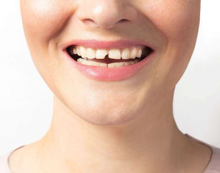 patient needing emergency care for a damaged tooth in Lugarno