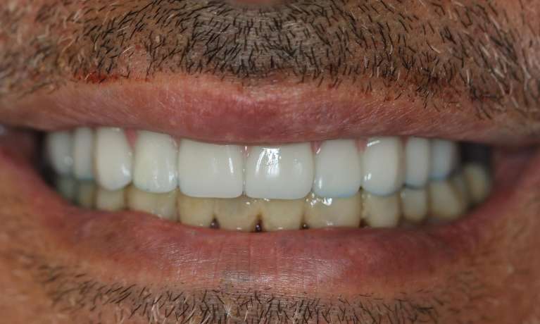 all on 4 after photos | dentist east hills