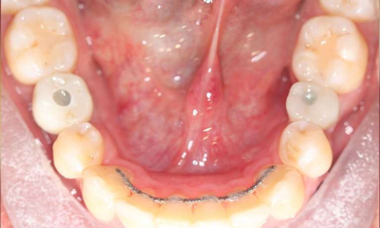 Dental Implants Panania After
