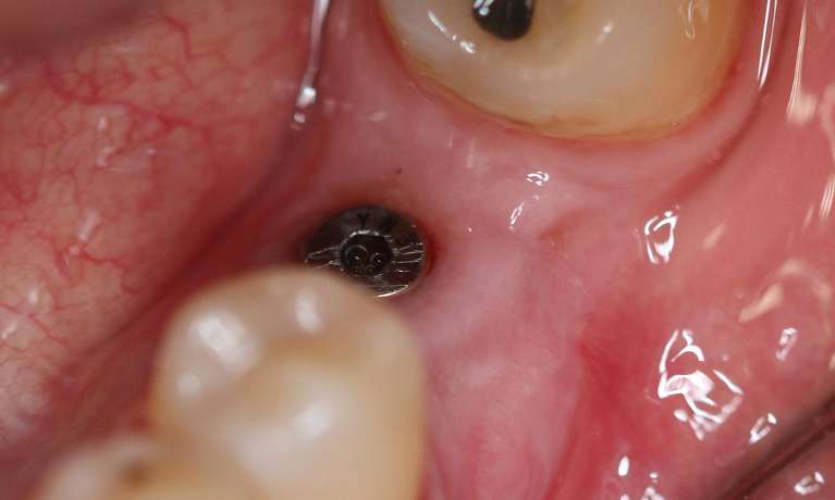 dental surgery before and after | Implant After