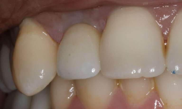 Tooth Trauma East Hills Dental Implant after repair