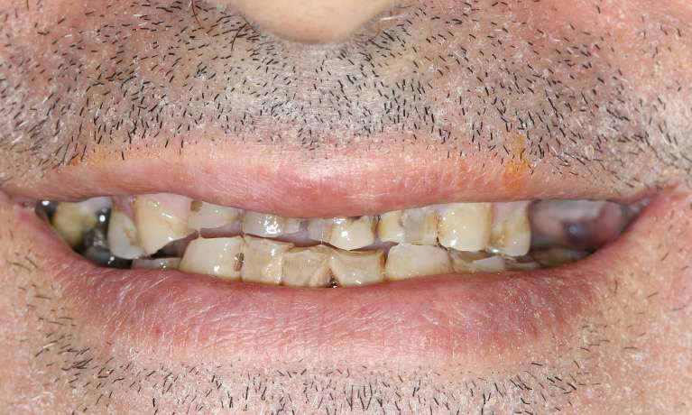 all on 4 before photos | dentist east hills
