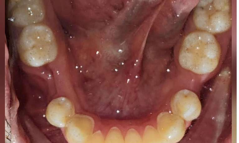 Dental Implants Panania Before