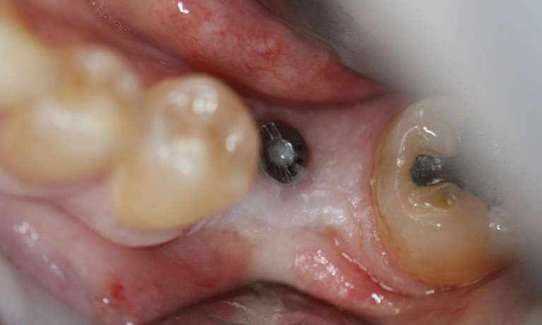 dental surgery before and after | Implant Before
