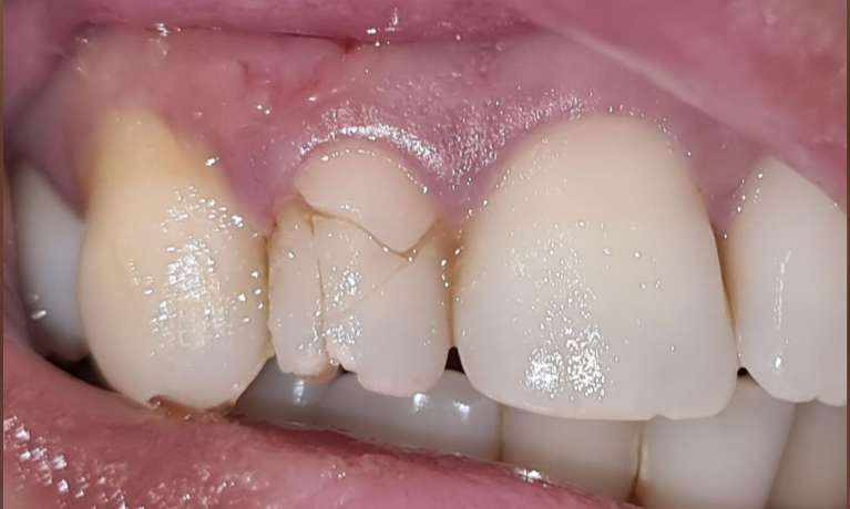 Tooth Trauma East Hills before repair