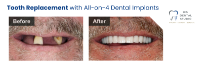 before and after all-on-4 dental implants